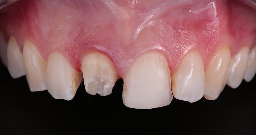 17444-Tooth-preparations-850x450