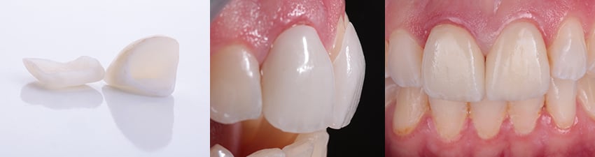 17444-Zirconia-crown-composite-850x225