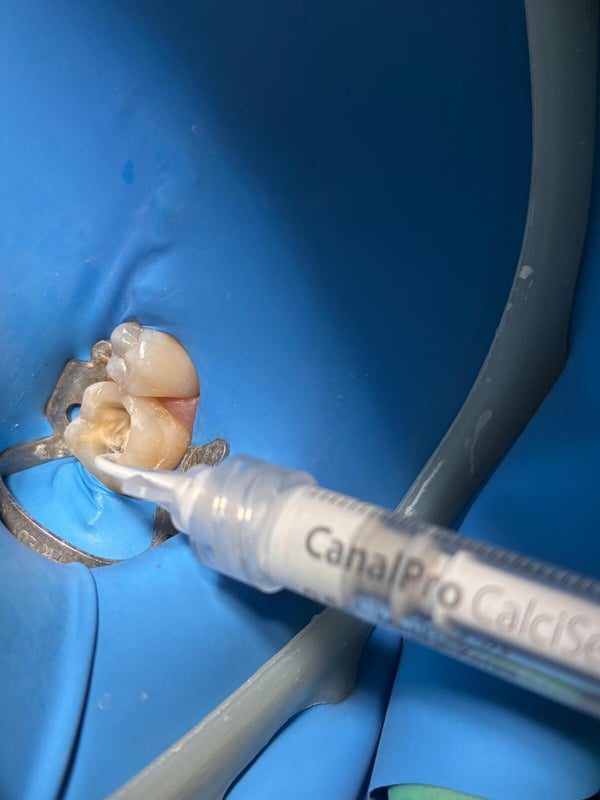 CalciSeal1_1