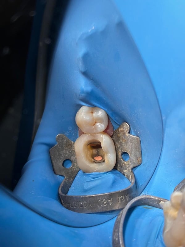 CalciSeal1_2