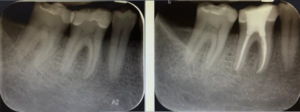 CalciSeal1_4