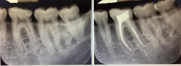 CalciSeal2_3