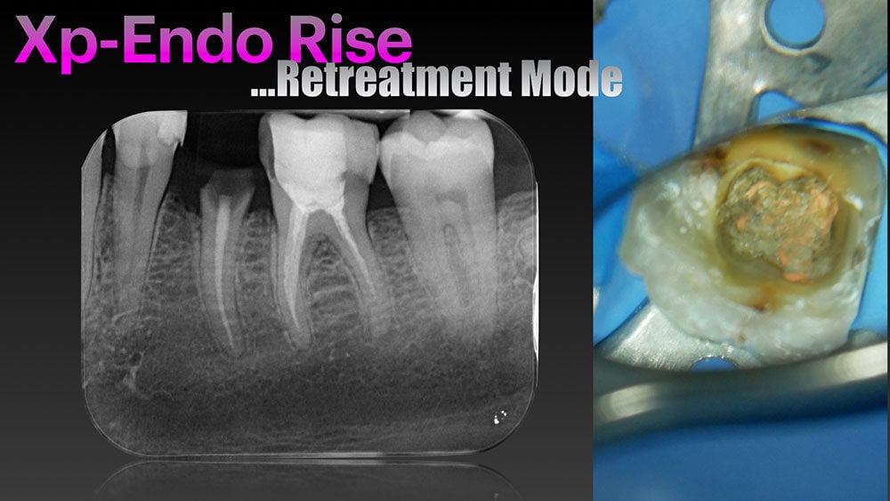 De-Luca-RTC-XP-ENDO-RISE1