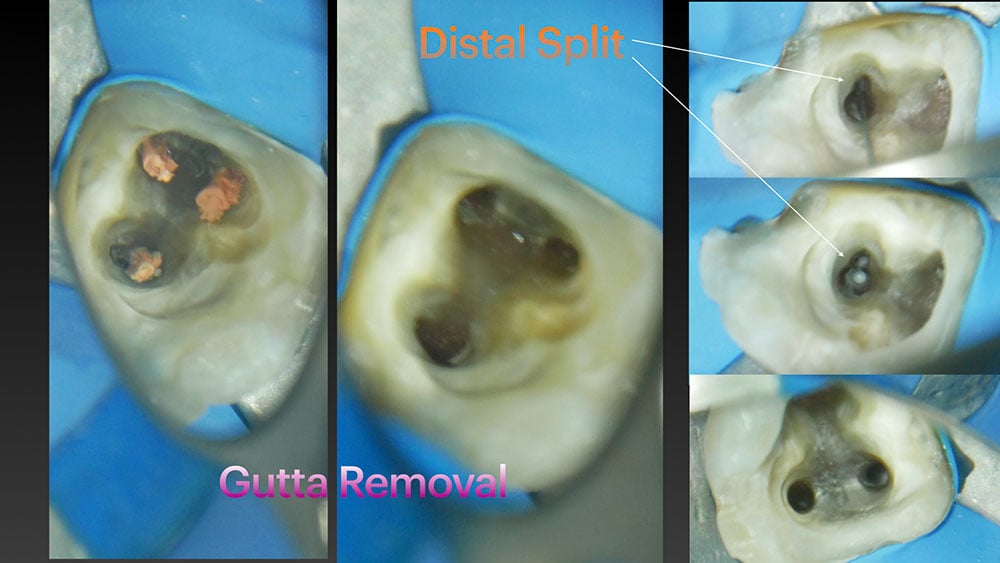 De-Luca-RTC-XP-ENDO-RISE2