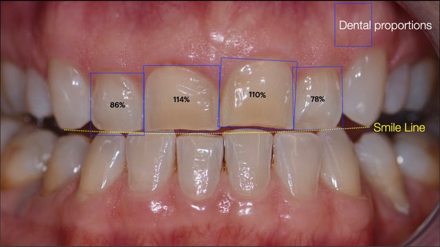 Fig 4 Analisi delle Proporzioni dentali