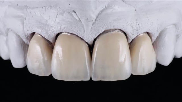 Figure 12 Veneers su Modello Master