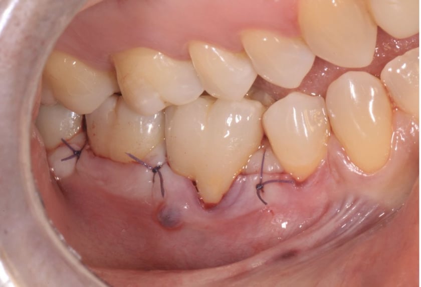 Riparazione chirurgica di estesa perforazione da stripping nella radice mesiale di molare Riparazione chirurgica di estesa perforazione da stripping nella radice mesiale di molare