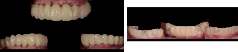 Lavorgna_Full-digital-implant-workflow-a-5-years-follow-up-10