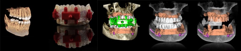 Lavorgna_Full-digital-implant-workflow-a-5-years-follow-up-16
