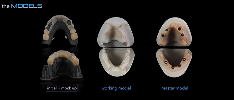 Lavorgna_Full-digital-implant-workflow-a-5-years-follow-up-19