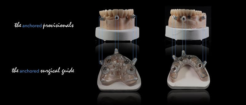 Lavorgna_Full-digital-implant-workflow-a-5-years-follow-up-23