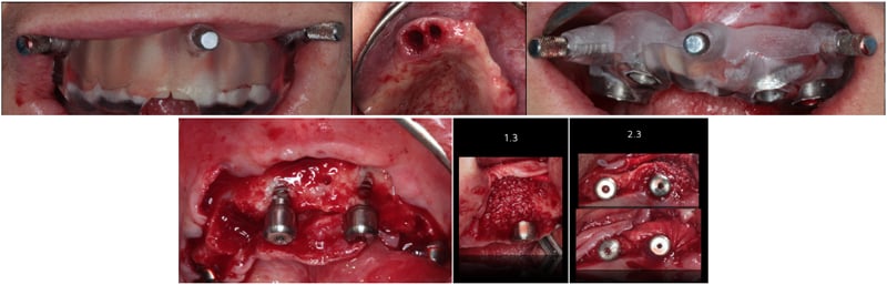 Lavorgna_Full-digital-implant-workflow-a-5-years-follow-up-25