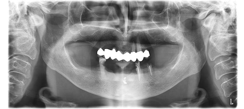 Lavorgna_Full-digital-implant-workflow-a-5-years-follow-up-3