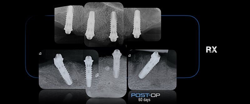 Lavorgna_Full-digital-implant-workflow-a-5-years-follow-up-38