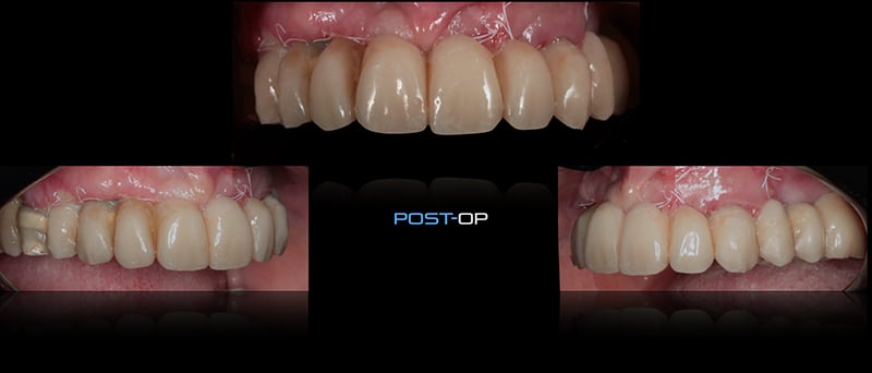 Lavorgna_Full-digital-implant-workflow-a-5-years-follow-up-39