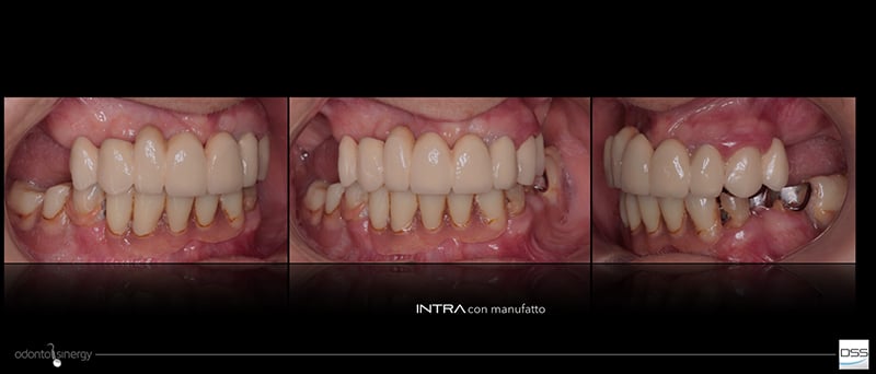 Lavorgna_Full-digital-implant-workflow-a-5-years-follow-up-4