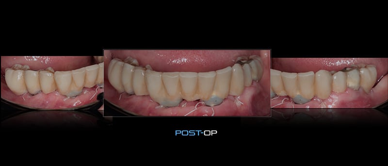 Lavorgna_Full-digital-implant-workflow-a-5-years-follow-up-40