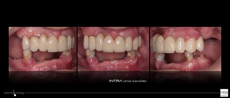 Lavorgna_Full-digital-implant-workflow-a-5-years-follow-up-5