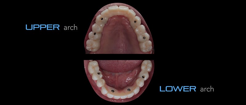 Lavorgna_Full-digital-implant-workflow-a-5-years-follow-up-50