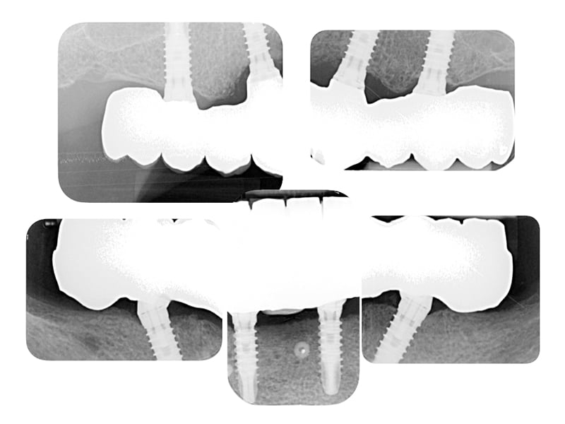 Lavorgna_Full-digital-implant-workflow-a-5-years-follow-up-51