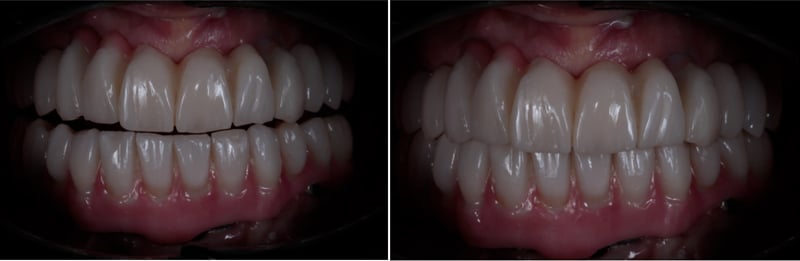 Lavorgna_Full-digital-implant-workflow-a-5-years-follow-up-66