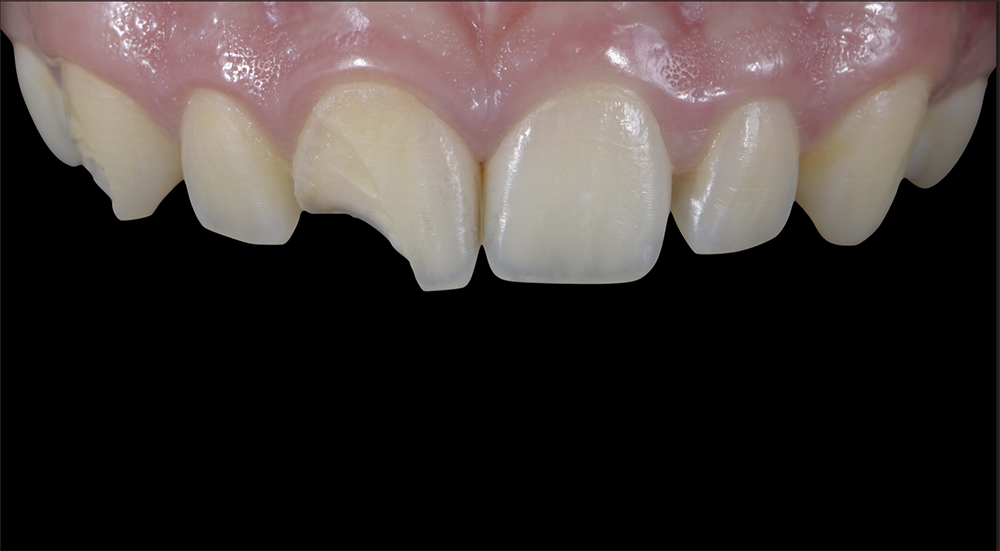 RS1118_1. tooth fracrture