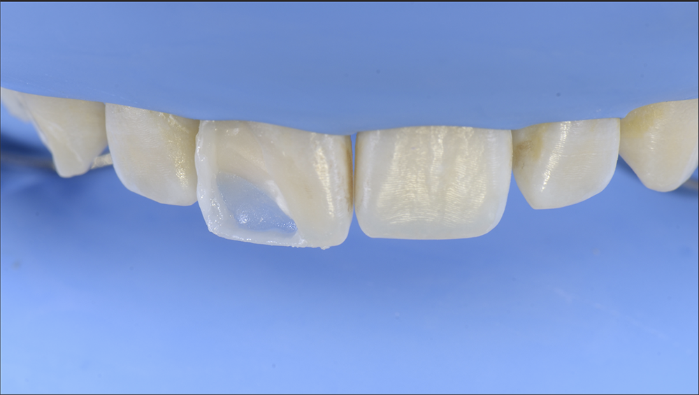 RS1121_6. incsial margin