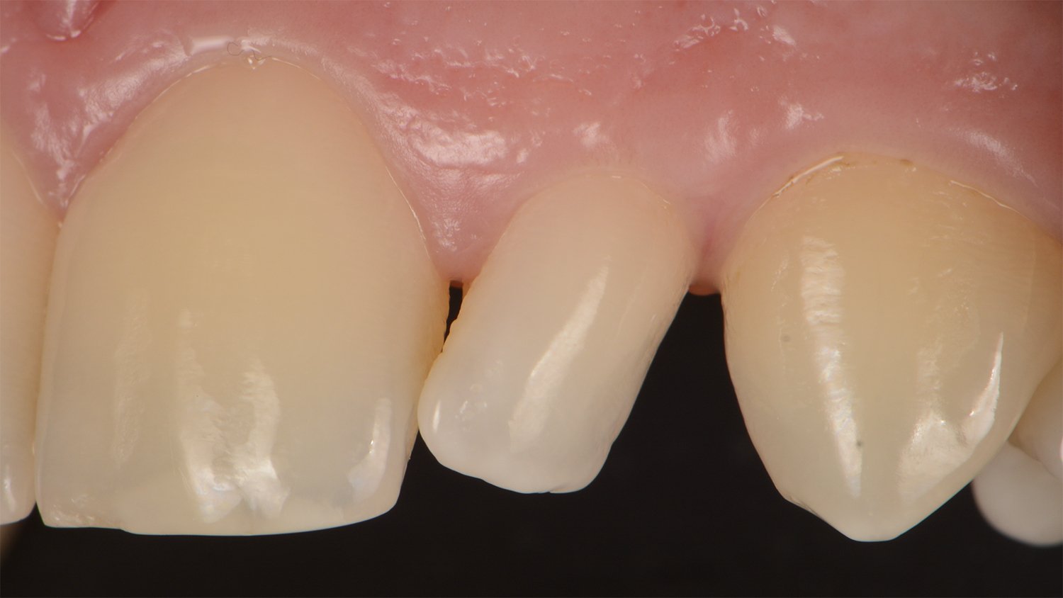 fem-devoto-peg-shaped-lateral-clinical-image001-ds-rps-en
