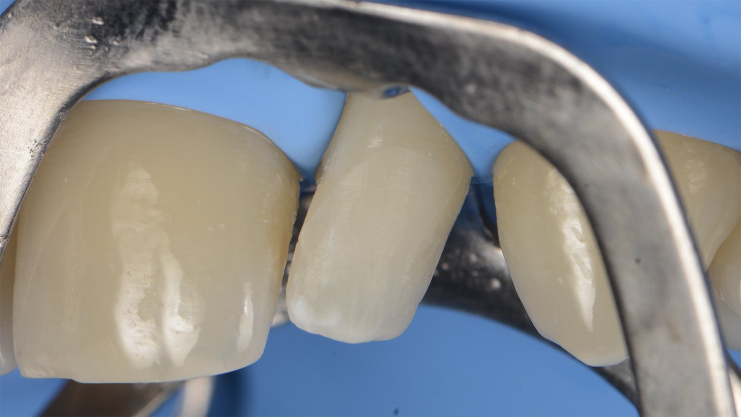 fem-devoto-peg-shaped-lateral-clinical-image003-ds-rps-en