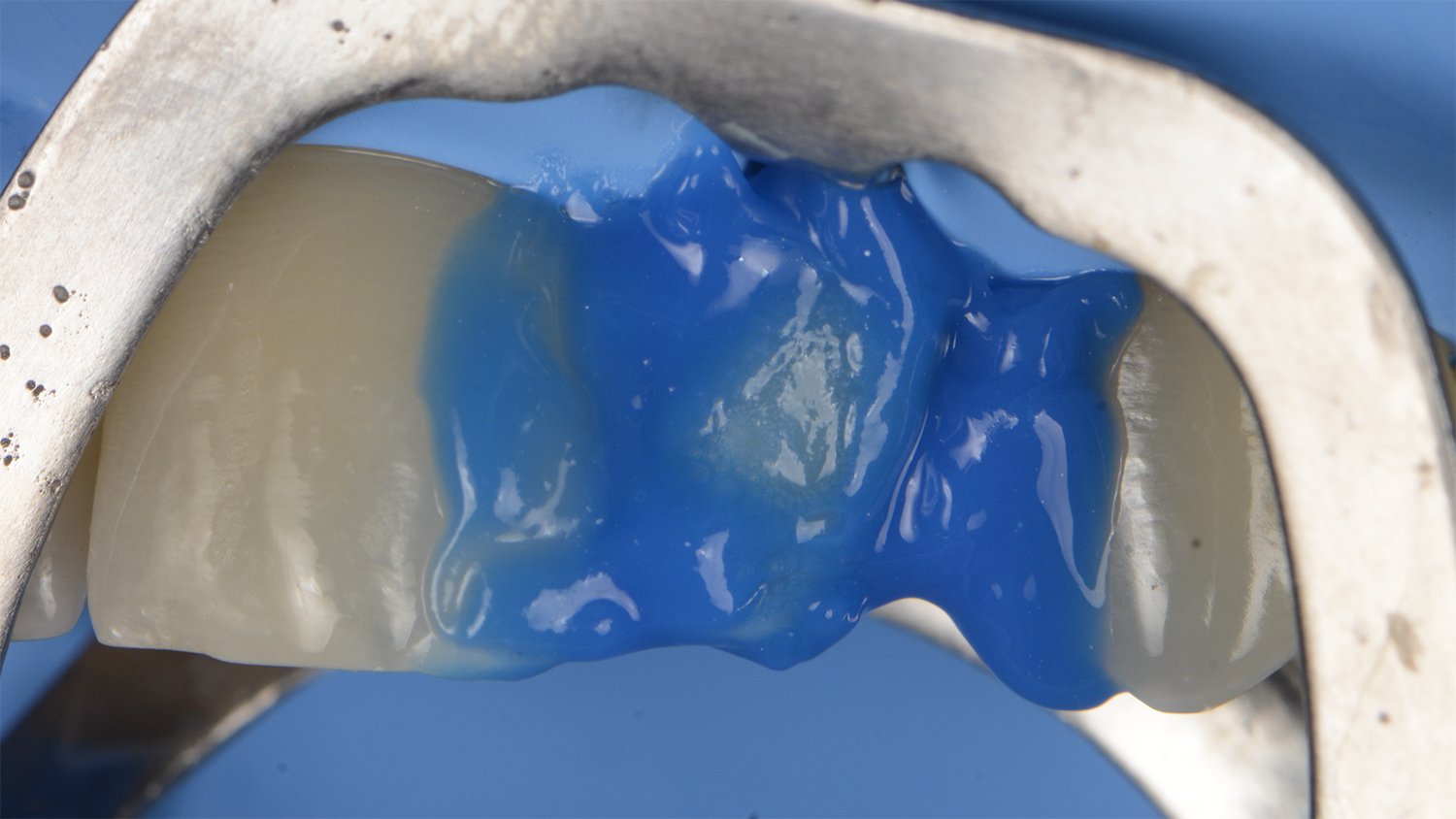 fem-devoto-peg-shaped-lateral-clinical-image004-ds-rps-en