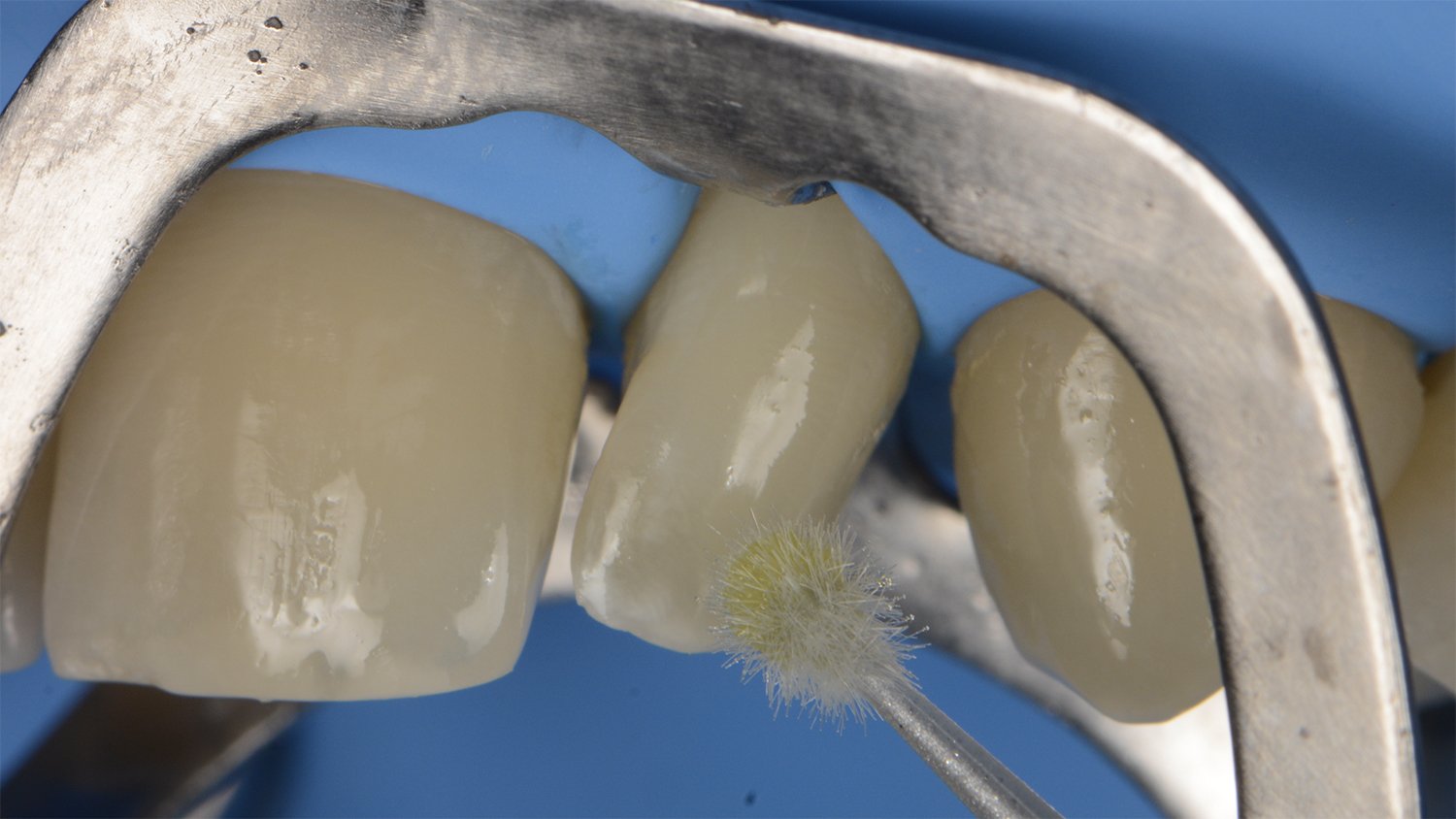 fem-devoto-peg-shaped-lateral-clinical-image006-ds-rps-en
