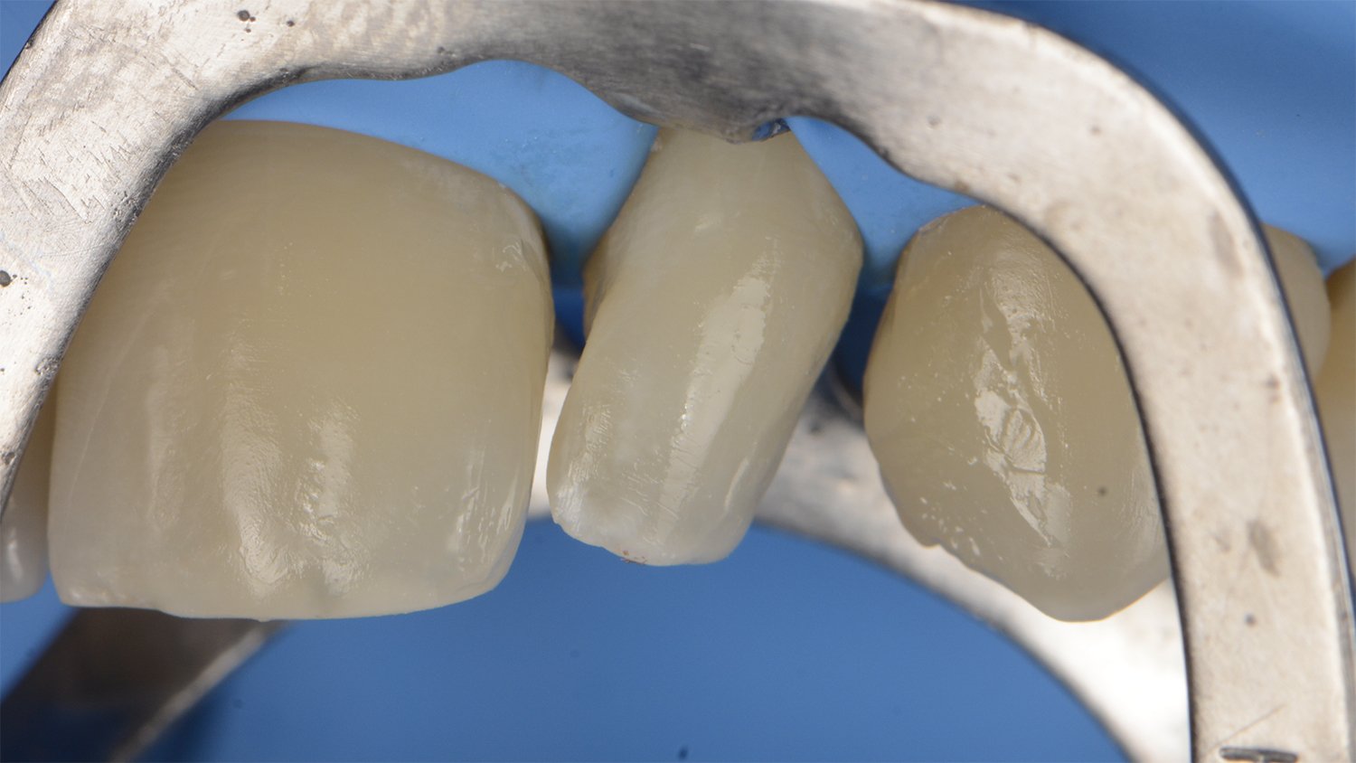 fem-devoto-peg-shaped-lateral-clinical-image007-ds-rps-en