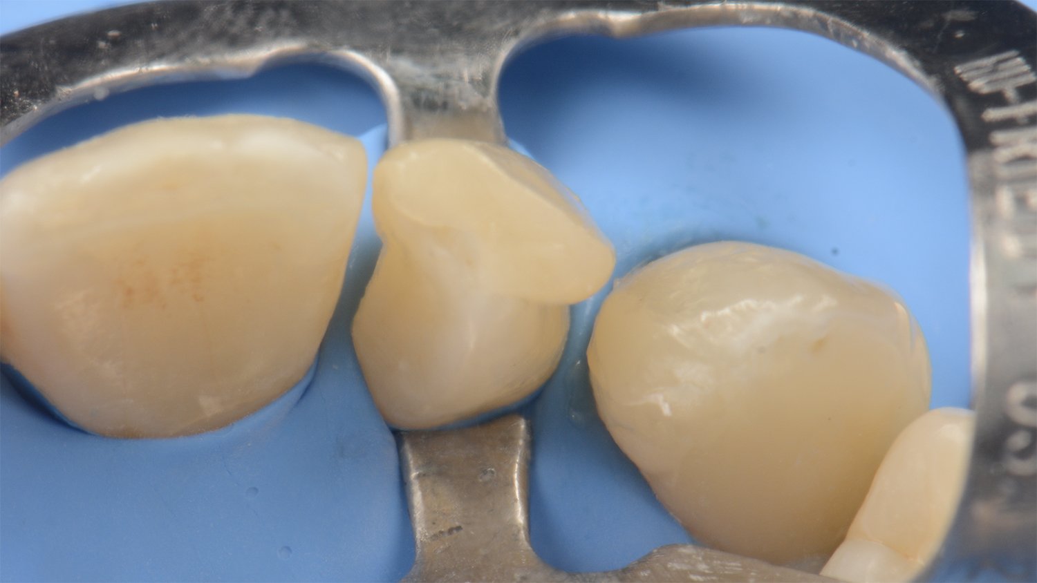 fem-devoto-peg-shaped-lateral-clinical-image009-ds-rps-en