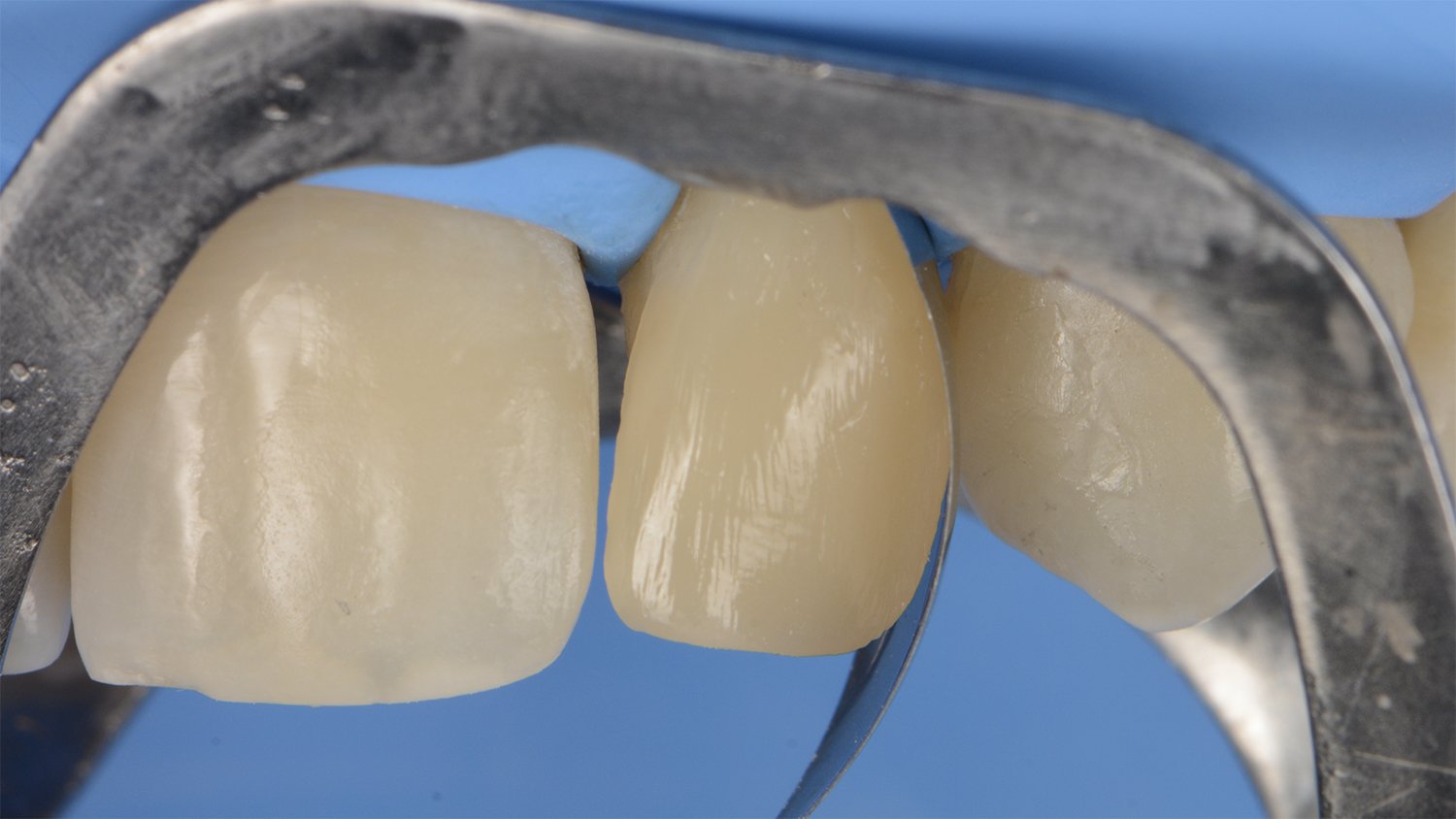 fem-devoto-peg-shaped-lateral-clinical-image011-ds-rps-en