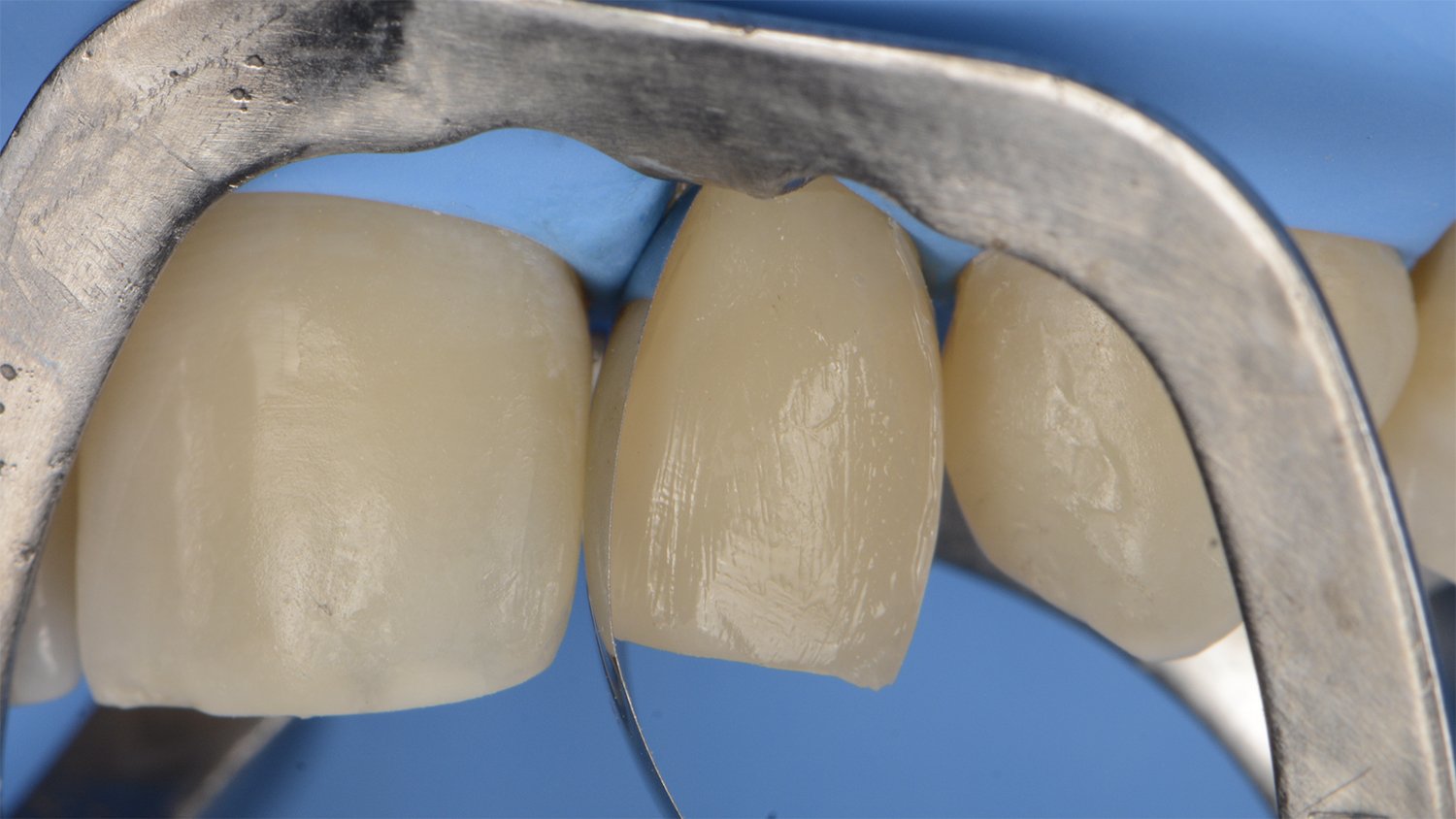fem-devoto-peg-shaped-lateral-clinical-image014-ds-rps-en