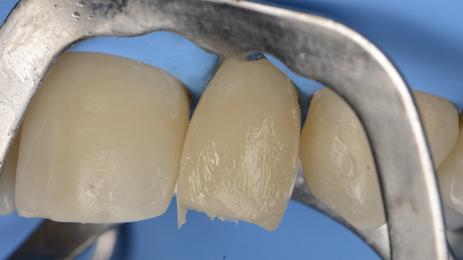 fem-devoto-peg-shaped-lateral-clinical-image015-ds-rps-en