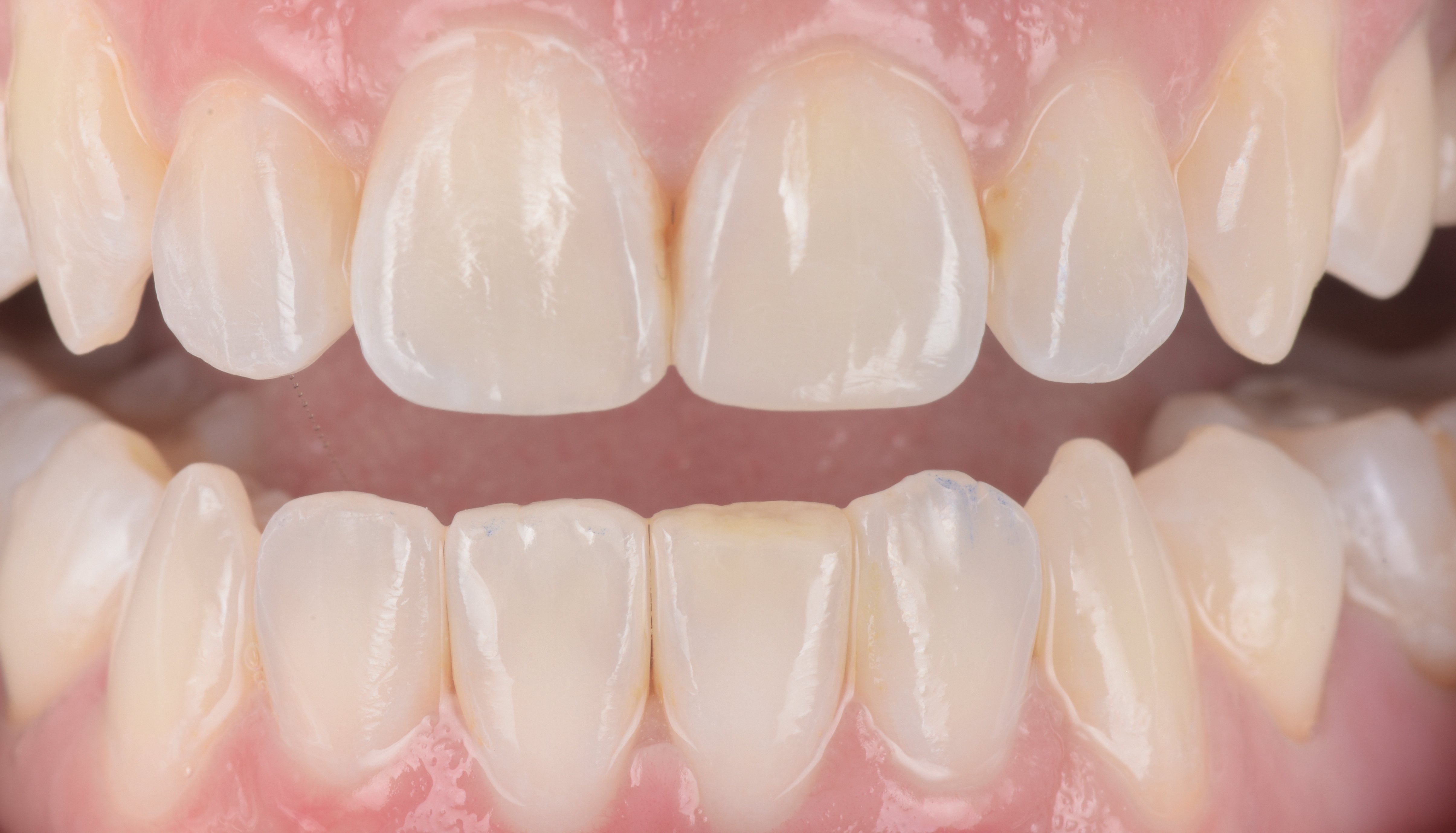 filtek-easy-match-flowable-post-ortho-refinement-clinical05-2-rgb-cropped-ds-rps-en