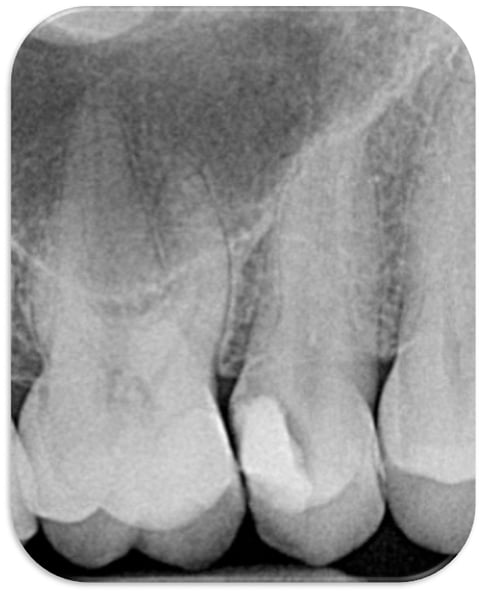 img-1-endo-rovai