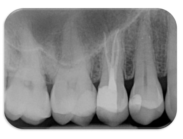 img-7-endo-rovai