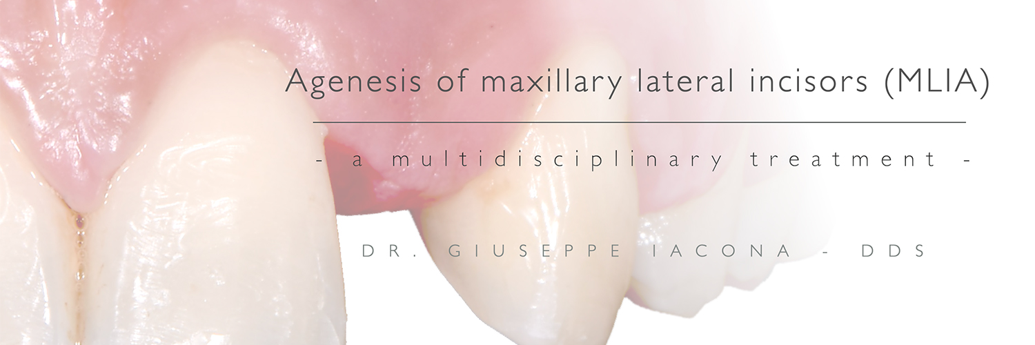 Agenesis of maxillary lateral incisors (MLIA) - A multidisciplinary treatment