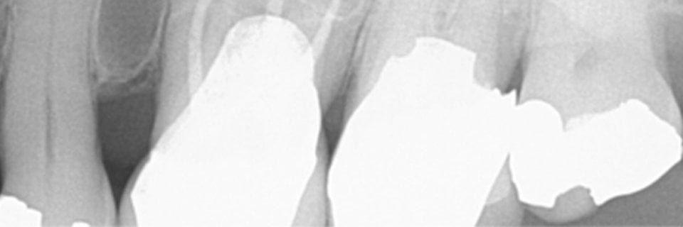 Endodontic Case Report: Tooth #26 - Dr. Jared King