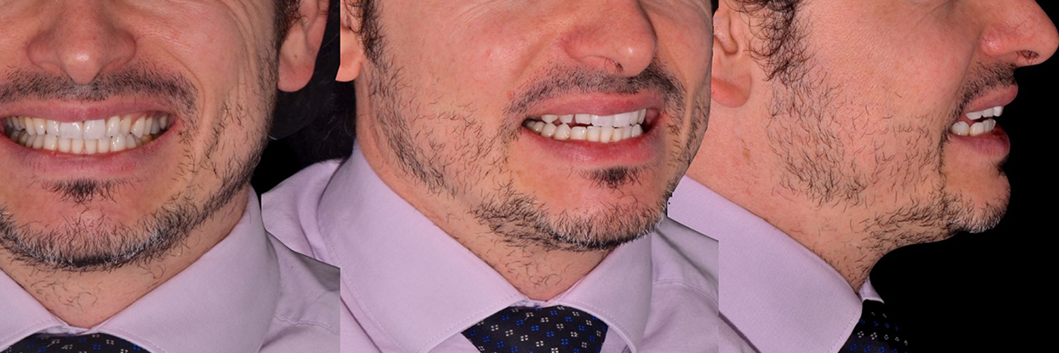 Rifacimento di due faccette in disilicato di litio, step clinici e sbiancamento domiciliare con White Dental Beauty al 10%