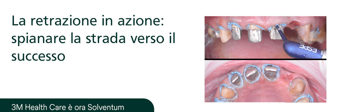 La retrazione in azione: spianare la strada verso il successo