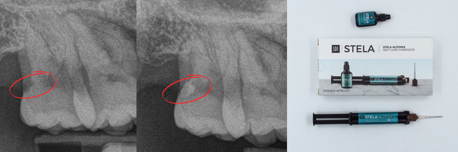 Stela: restauri senza limiti - Caso Clinico