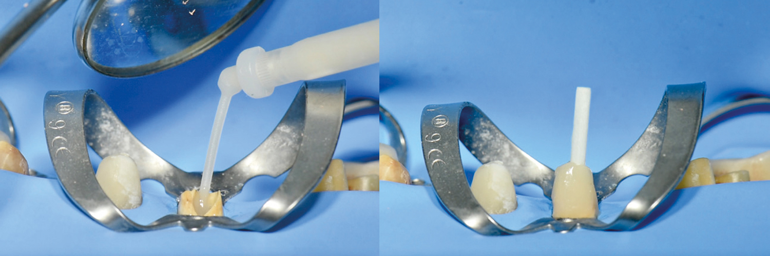 Utilizzo dei cementi resinosi nelle riabilitazioni protesiche in odontoiatria