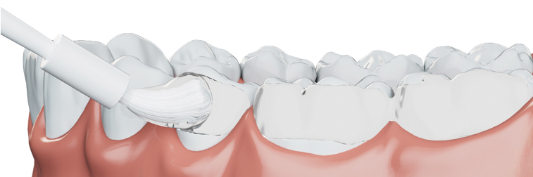 Meno fluoro, più efficacia: scopri 3M™ Clinpro™ Clear, il trattamento al fluoro di nuova generazione, ben tollerato dai pazienti!