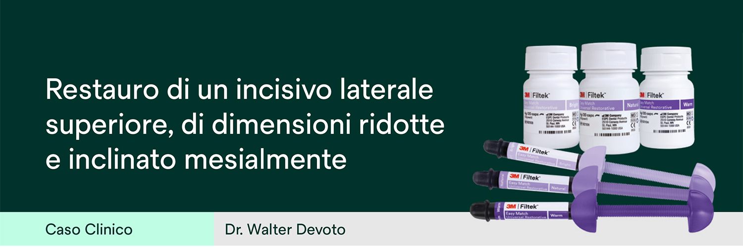 Restauro di un incisivo laterale superiore, di dimensioni ridotte e inclinato mesialmente