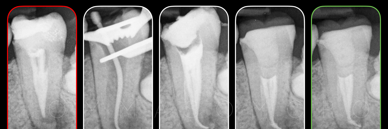Caso clinico di una lesione periapicale a carico dell’elemento 3.7, già trattato endodonticamente in maniera incongrua