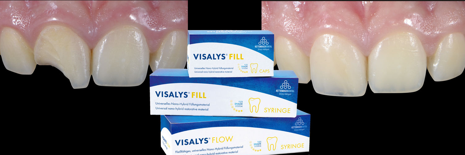 Ricostruzione estetica di elemento dentale fratturato