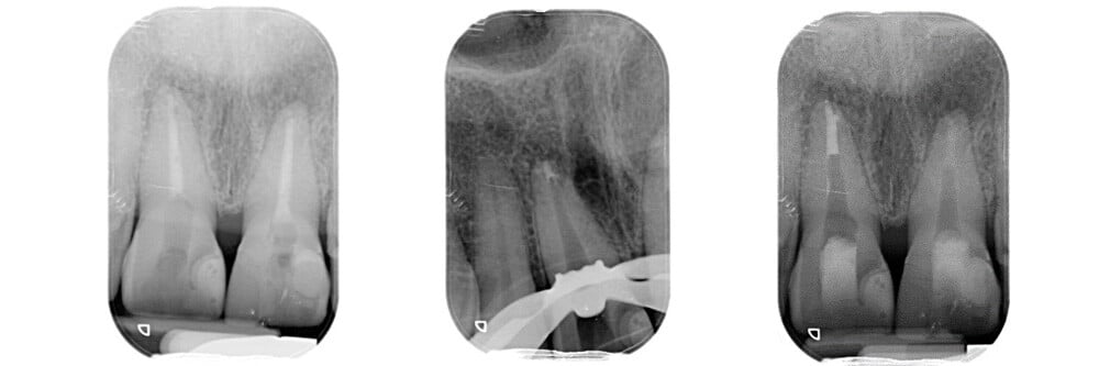 Terapia endodontica per anatomie alterate